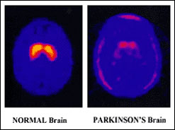 Brain scans