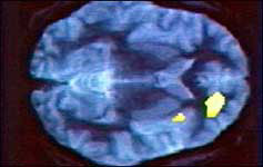 Brain scan