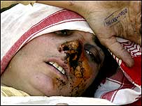 Injured woman