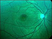 Eye and tear